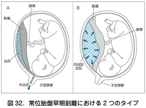 胎盤形成時期|胎盤の役割は？重さや完成時期、石灰化や遺残、胎盤。